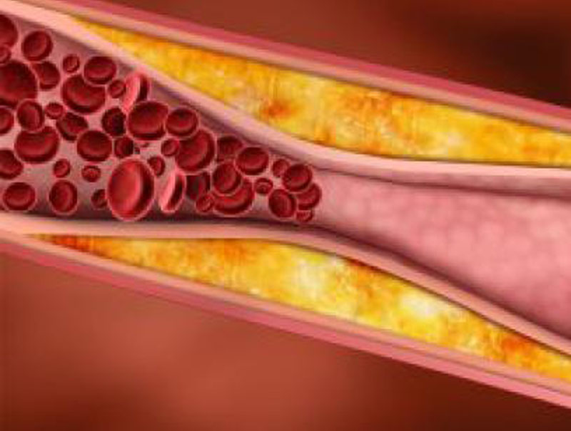 Ateroesclerosis, la enfermedad cardiovascular que se lleva más vidas en el mundo